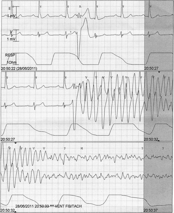 EKG som viser polymorf ventrikkeltakykardi som degenererer til ventrikkelflimmer. Av Bagnall et al.: BMC Medical Genetics 15 (2014): 99.