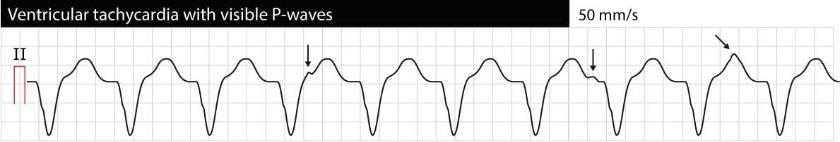 Figur 1. Monomorf ventrikkeltakykardi (VT, VTach). P-bølger er synlige, men de har ingen relasjon til QRS-kompleksene. Denne situasjonen kalles &laquo;AV-dissosiasjon&raquo; og indikerer at atriell og ventrikulær aktivitet er uavhengige. AV-dissosiasjon bekrefter at arytmien er ventrikulær takykardi. AV-dissosiasjon er imidlertid ofte vanskelig å oppdage.
