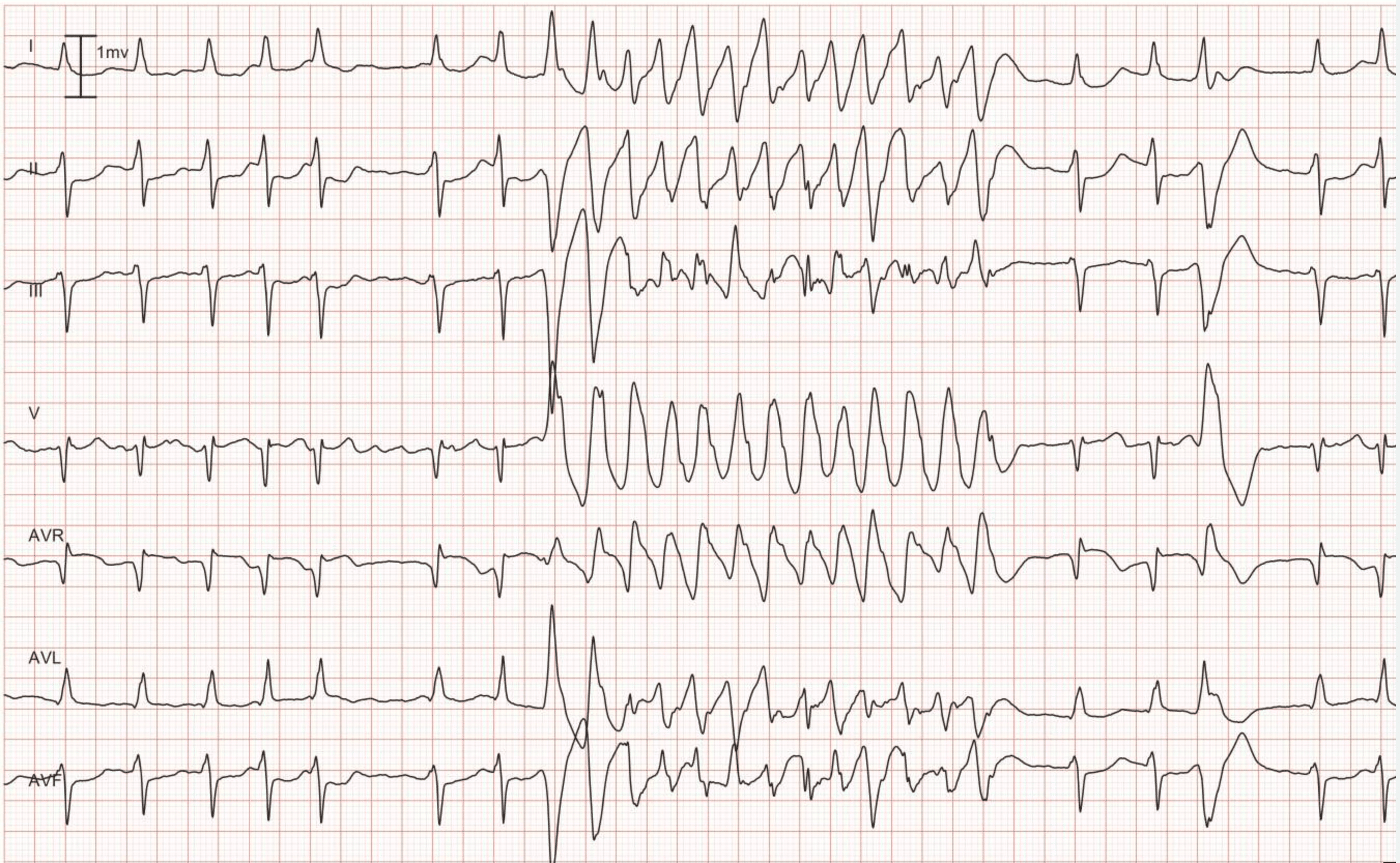 Figur 8. Avledning I, II, III, V1, aVR, aVL og aVF. I begynnelsen av registreringen ses en underliggende atrieflimmerrytme. Atrieflimmeret avbrytes av en rask, regelmessig takykardi med brede QRS-komplekser. Legg merke til det 4. slaget fra slutten; dette er et prematurt ventrikkelslag med samme QRS-morfologi som under takykardien. Takykardien har derfor også utgangspunkt i ventriklene, noe som innebærer at den er ventrikkeltakykardi (VT).