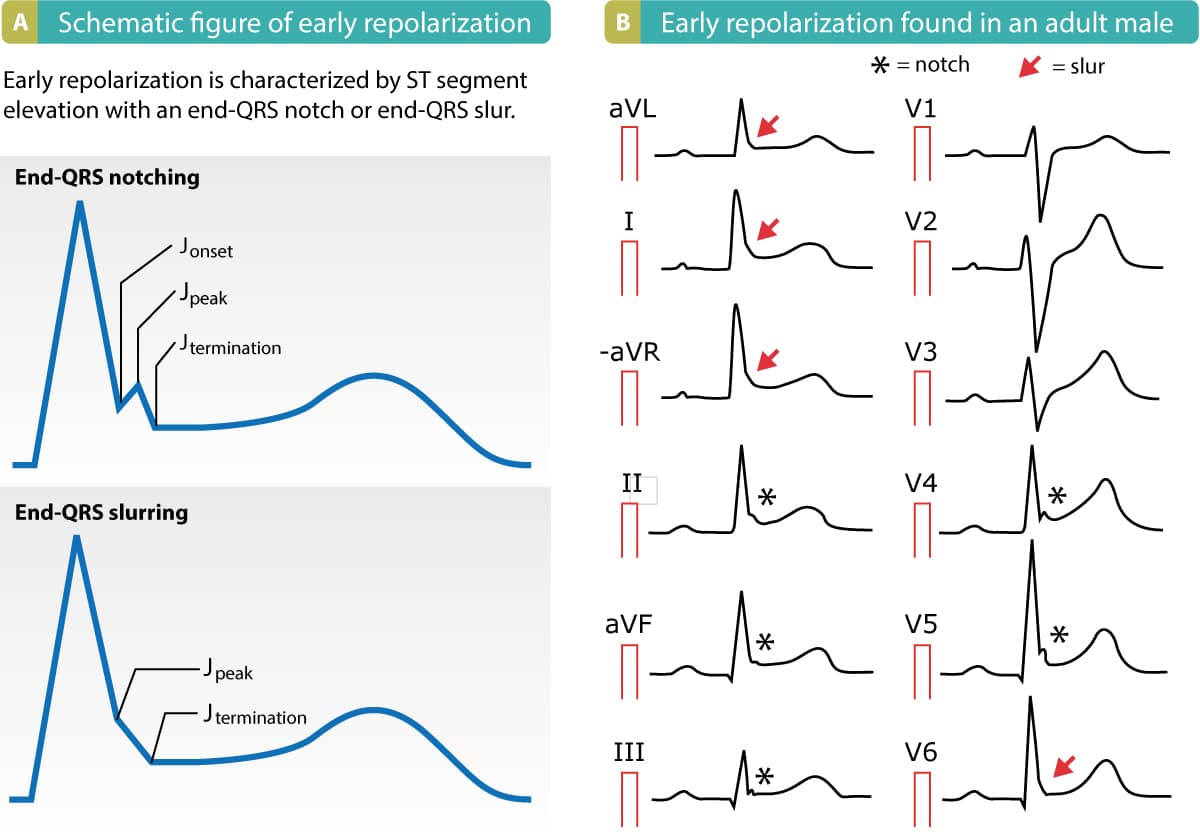 Figur 5. Tidlig repolarisering (etter MacFarlane et al., 2015, J Am Coll Cardiol)