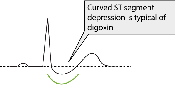 Figur 1. ST-segmentdepresjon ("hengekøye") som følge av digoksinbehandling (digitaliseffekt).