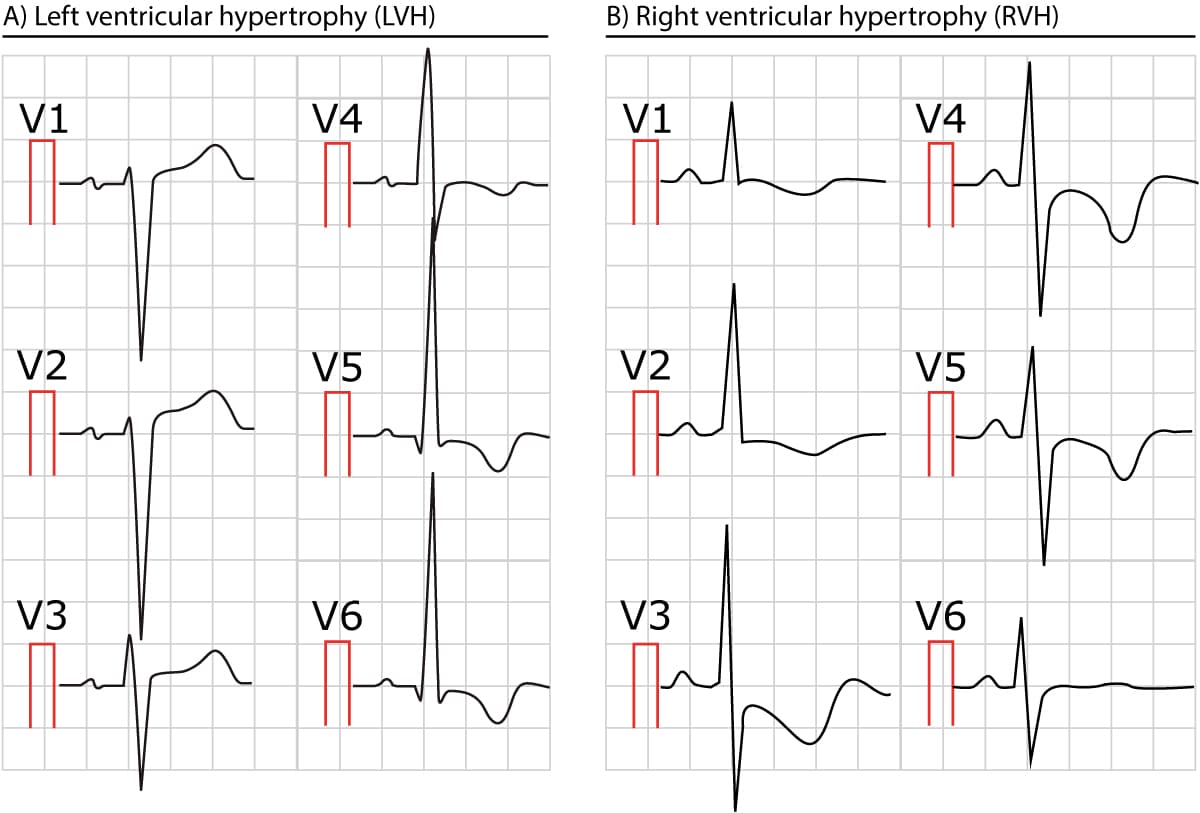 Figur 2. EKG som viser venstre (øverst) og høyre (nederst) ventrikkelhypertrofi.