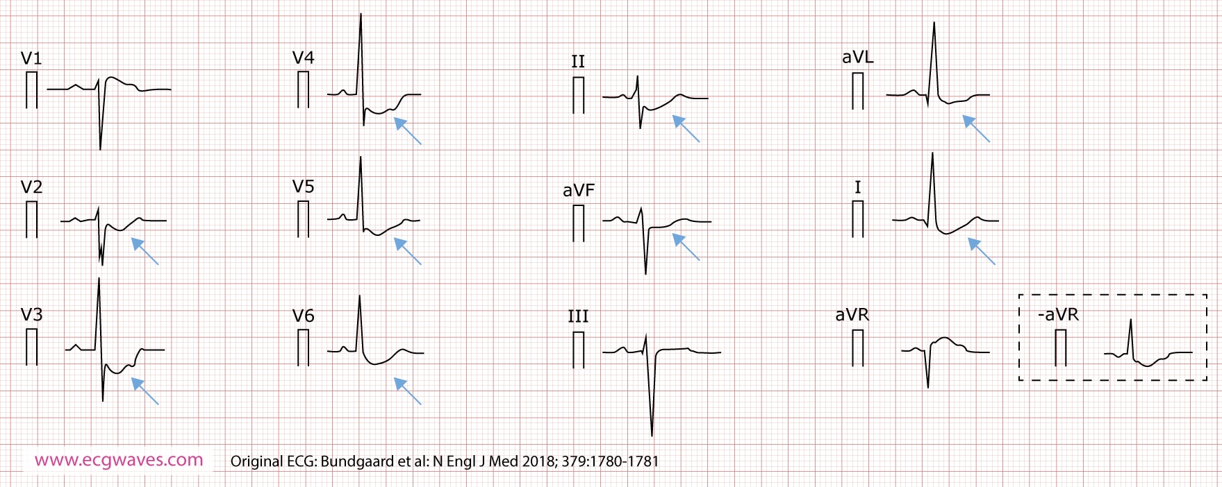 Figur 4. 12-avlednings-EKG (presentert i henhold til Cabrera), tatt ved 63 års alder, viser konkavt stigende ST-senkning i avledning I, II, aVL, aVF og V2 til V6, og ST-elevasjon i avledning aVR (som tilsvarer en identisk ST-senkning i den inverterte avledningen -aVR). Et hakk er tydelig i den stigende delen av ST-segmentet.