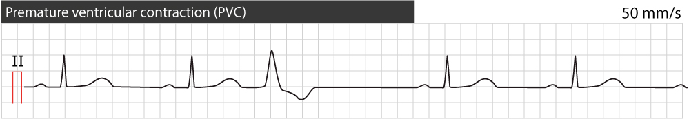 Figur 1. Prematur ventrikkelkontraksjon (kompleks/slag). Typisk utseende. Legg merke til papirhastigheten 50 mm/s (1 stor rute tilsvarer 100 ms).