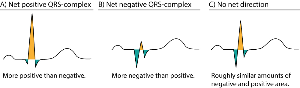 Figur 6. Tilnærming av nettoretningen til QRS-komplekset. De positive områdene er gule og de negative områdene er grønne