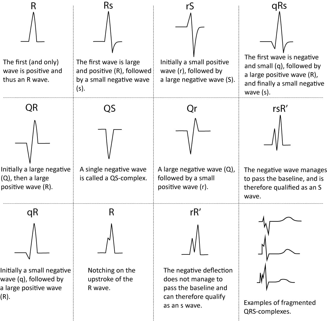 Figur 5. Navngivning av QRS-komplekset