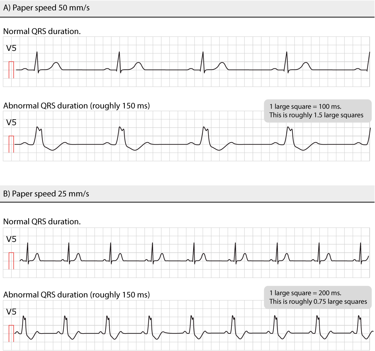 Figur 8. Normale og unormale QRS-varigheter ved ulike papirhastigheter