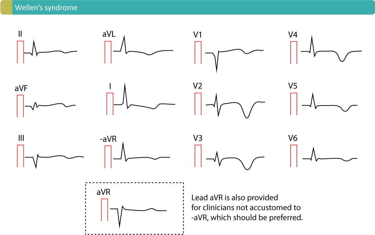 Wellens syndrom med bifasiske og dypt negative T-bølger i V2-V3