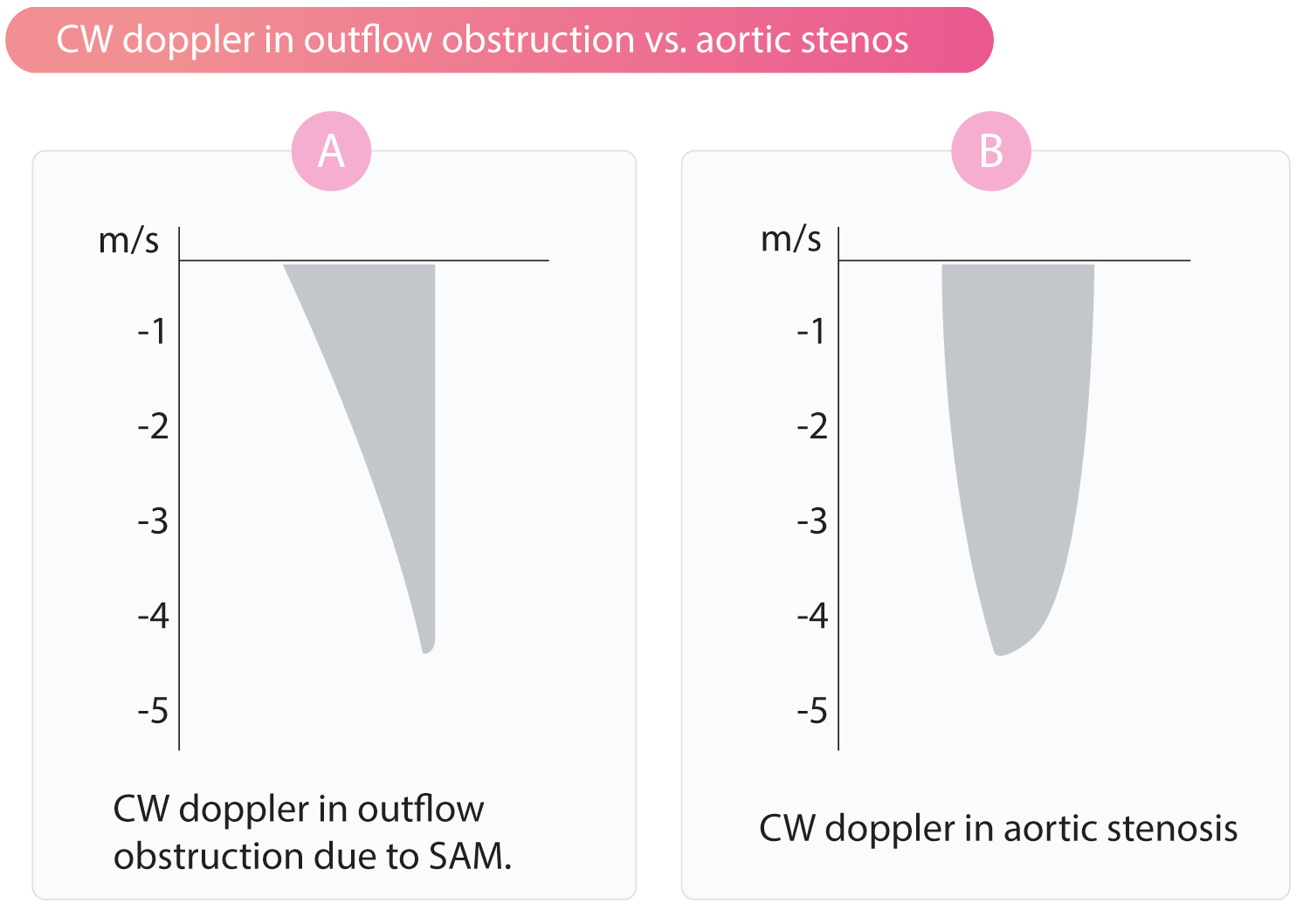 Figur 3. Kontinuerlig bølgedoppler (CW) i LVOT ved (A) dynamisk obstruksjon (dolkformet kurve) som følge av SAM og septumhypertrofi og (B) fast obstruksjon ved aortastenose (parabelformet).
