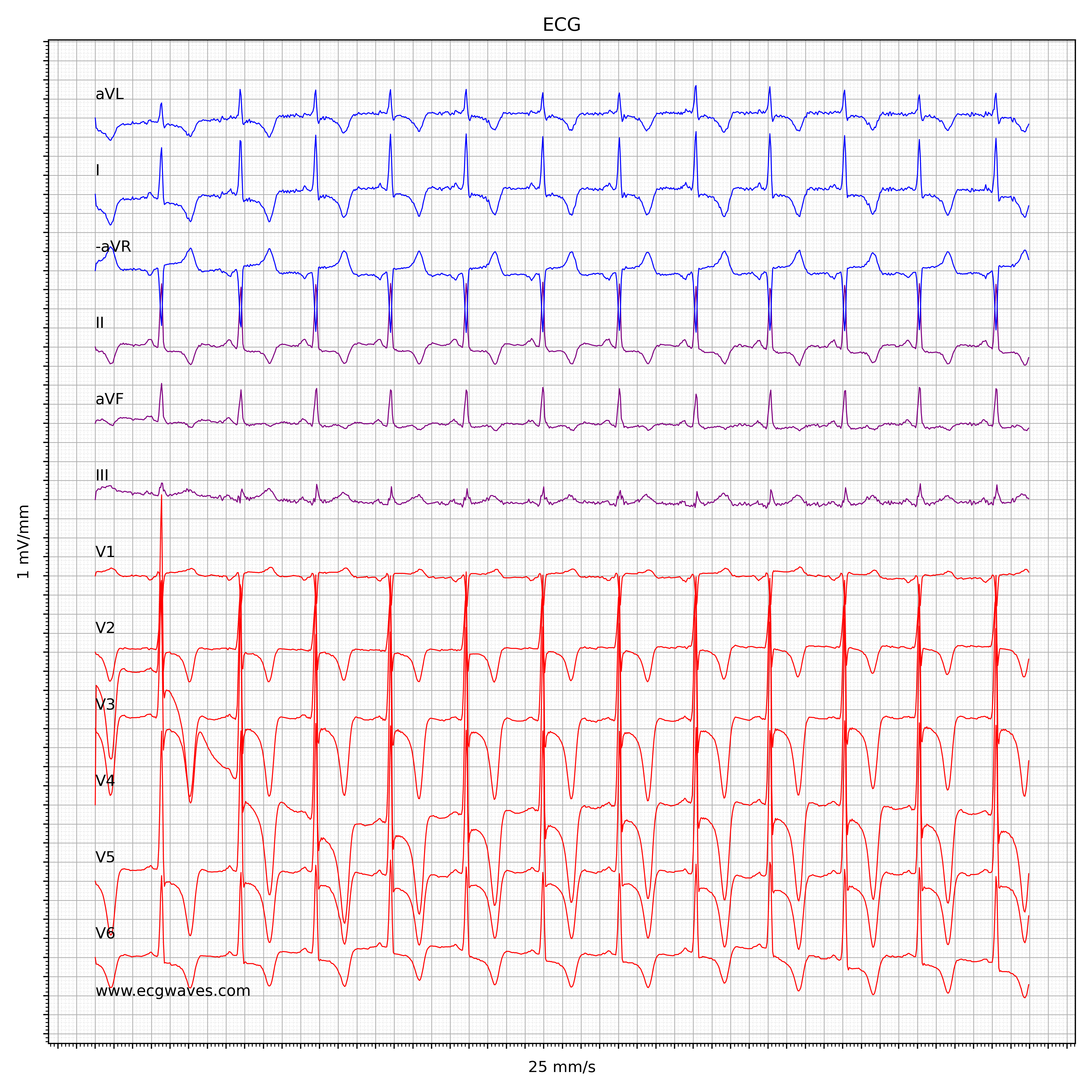 EKG ved hypertrofisk obstruktiv kardiomyopati (HCM/HOCM)