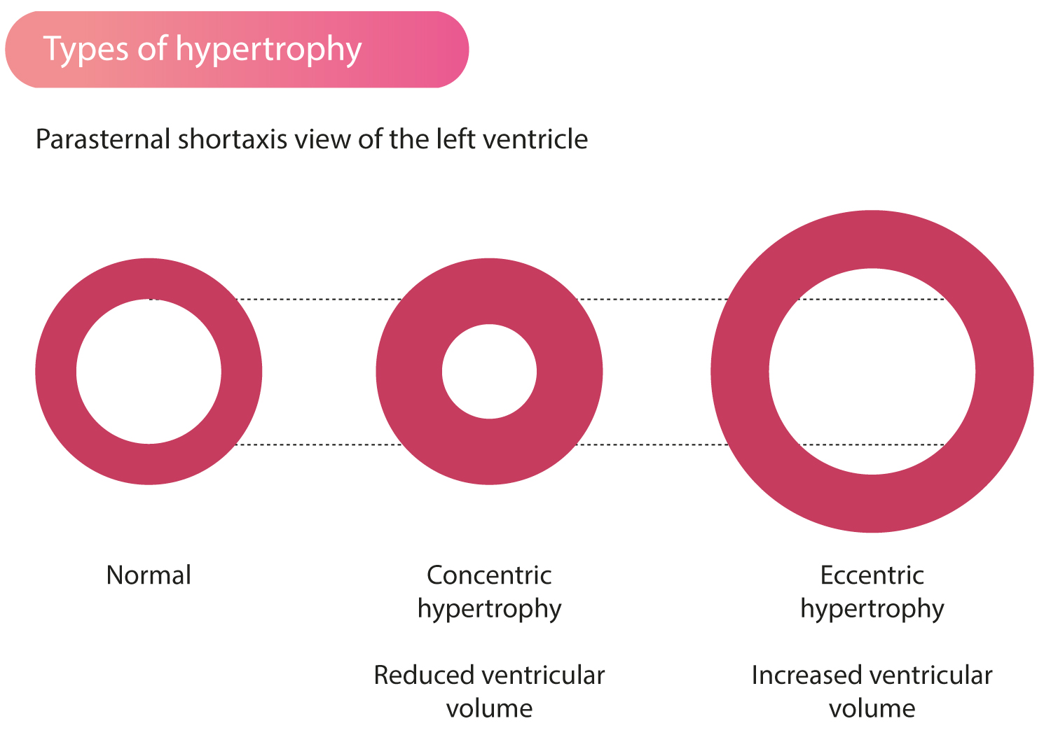 Figur 1. Typer av venstre ventrikkelhypertrofi. Venstre ventrikkelvolum reduseres ved konsentrisk hypertrofi/remodellering. Eksentrisk hypertrofi resulterer i økt ventrikkelvolum med relativt tynnere vegger.