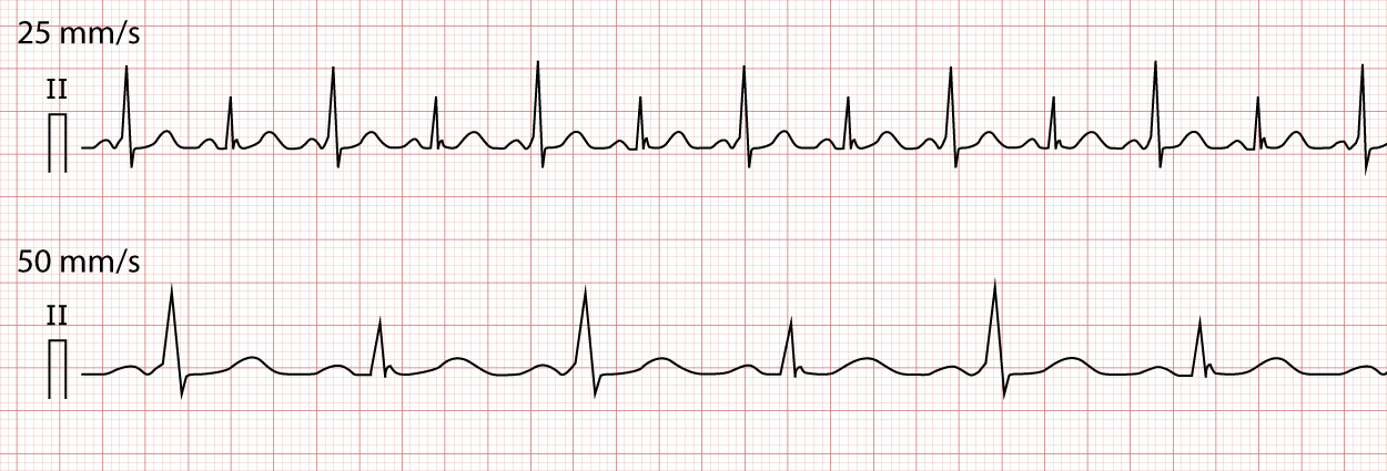Figur 6. EKG-registrering med varierende grad av preeksitasjon, noe som gir variasjoner i QRS-amplitude og bredde.