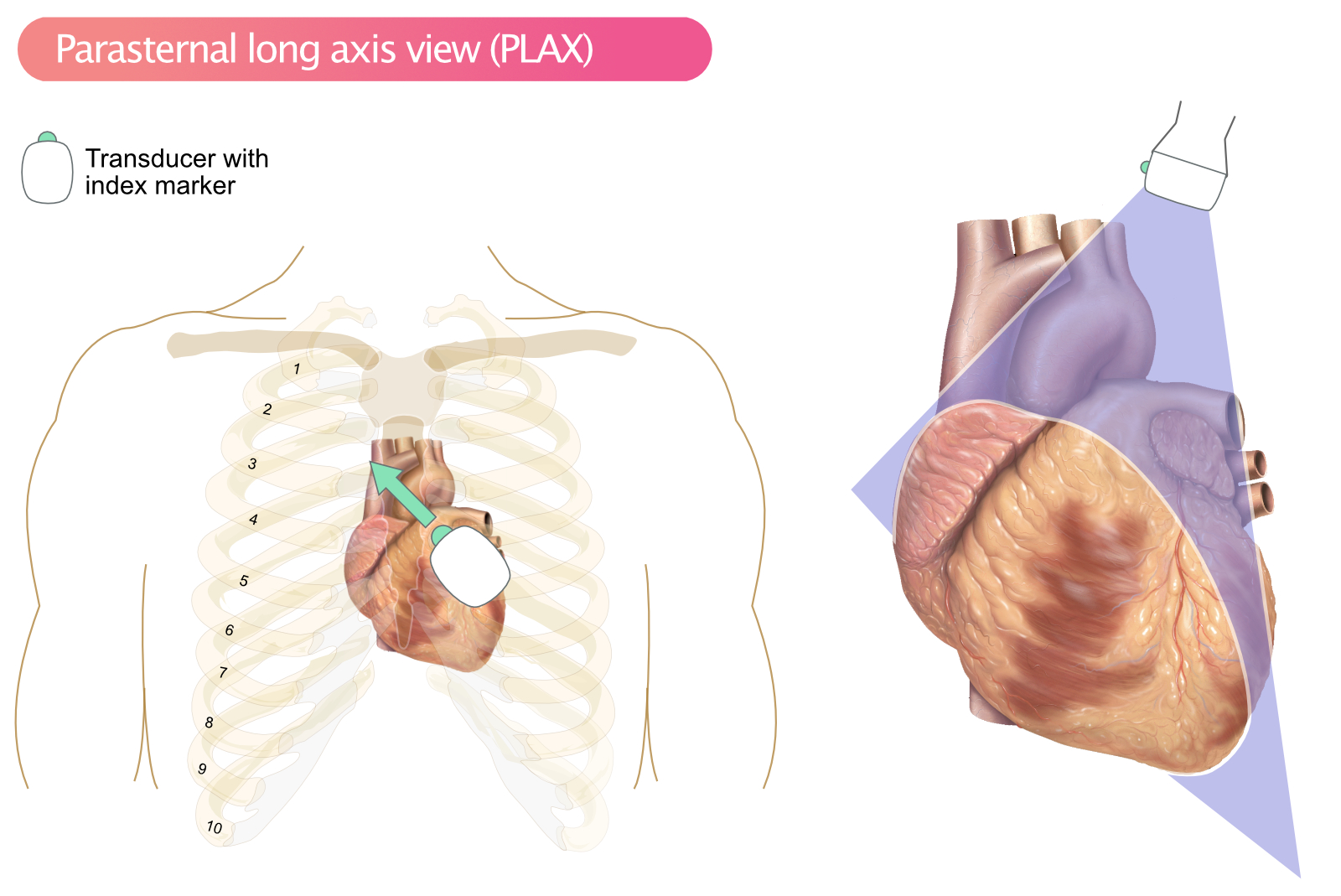 Figur 1. PLAX, parasternalt langaksesnitt.