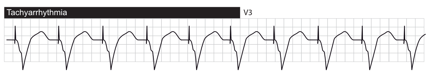 Takyarytmi med ventrikulær pacing.