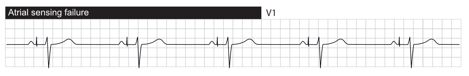 Svikt i sensing. Atriell pacing skjer etter den intrinsiske P-bølgen.