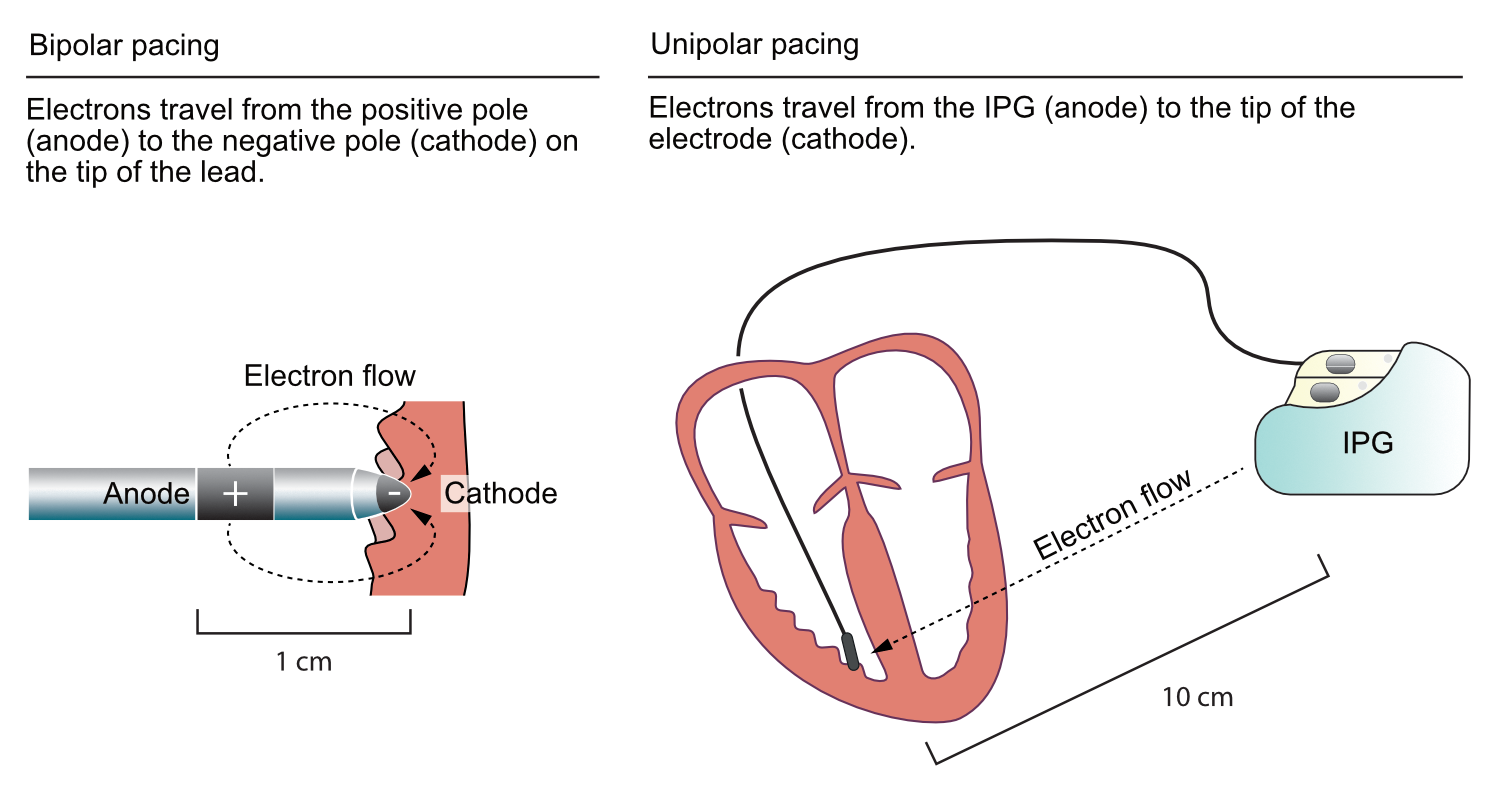 Figur 3. Unipolar vs. bipolar pacing.