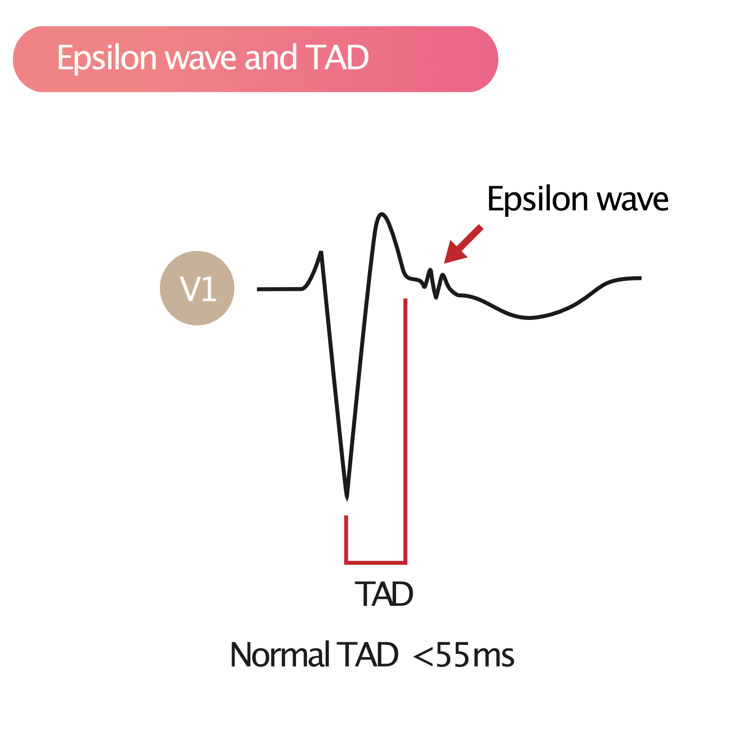 Figur 1. Epsilon-bølge og TAD på elektrokardiogrammet.