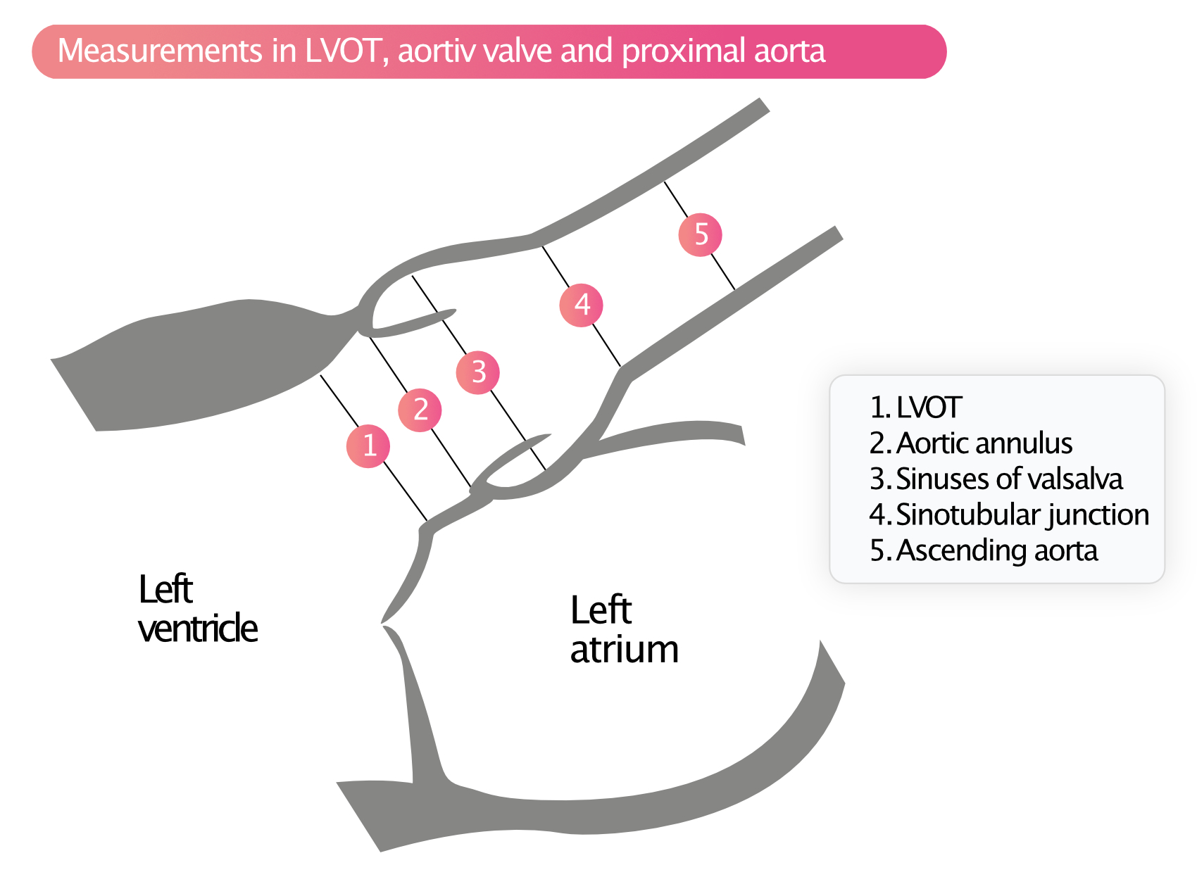 Figur 5. Målinger i LVOT, aortaklaffen og proksimale aorta.