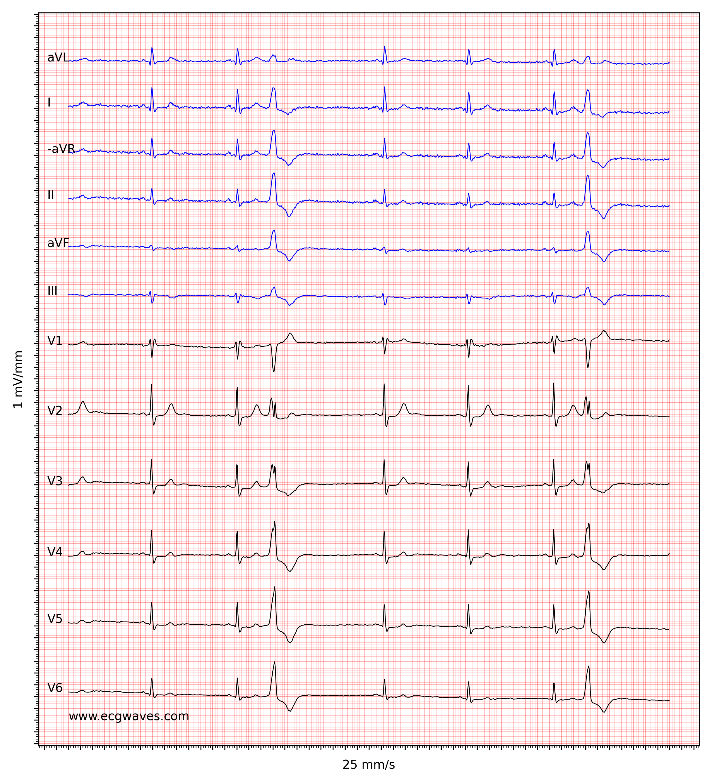 Figur 2. Sinusbradykardi, to premature ventrikulære kontraksjoner (VES), inkomplett høyre grenblokk og ST-senkninger i V2-V6. Klikk for å zoome.
