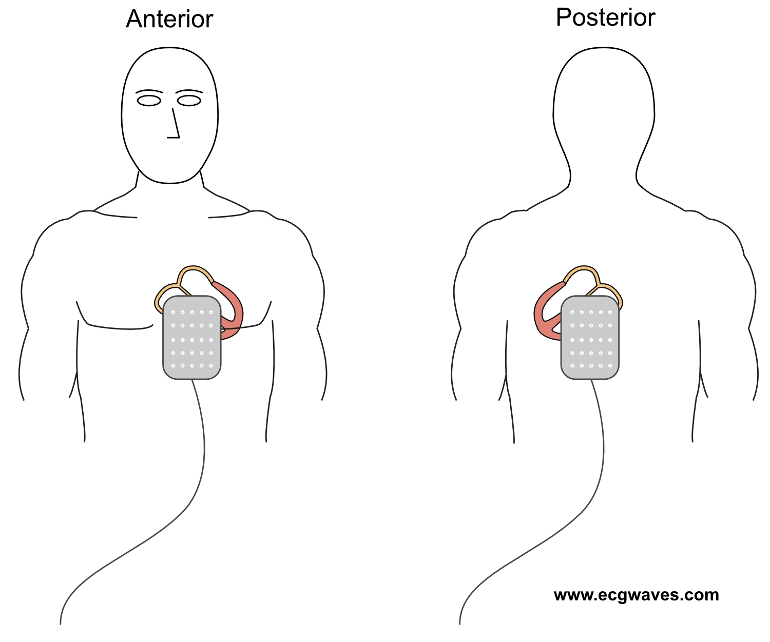 Figur 4. Plassering av elektroder i anteroposterior retning for transkutan pacing.