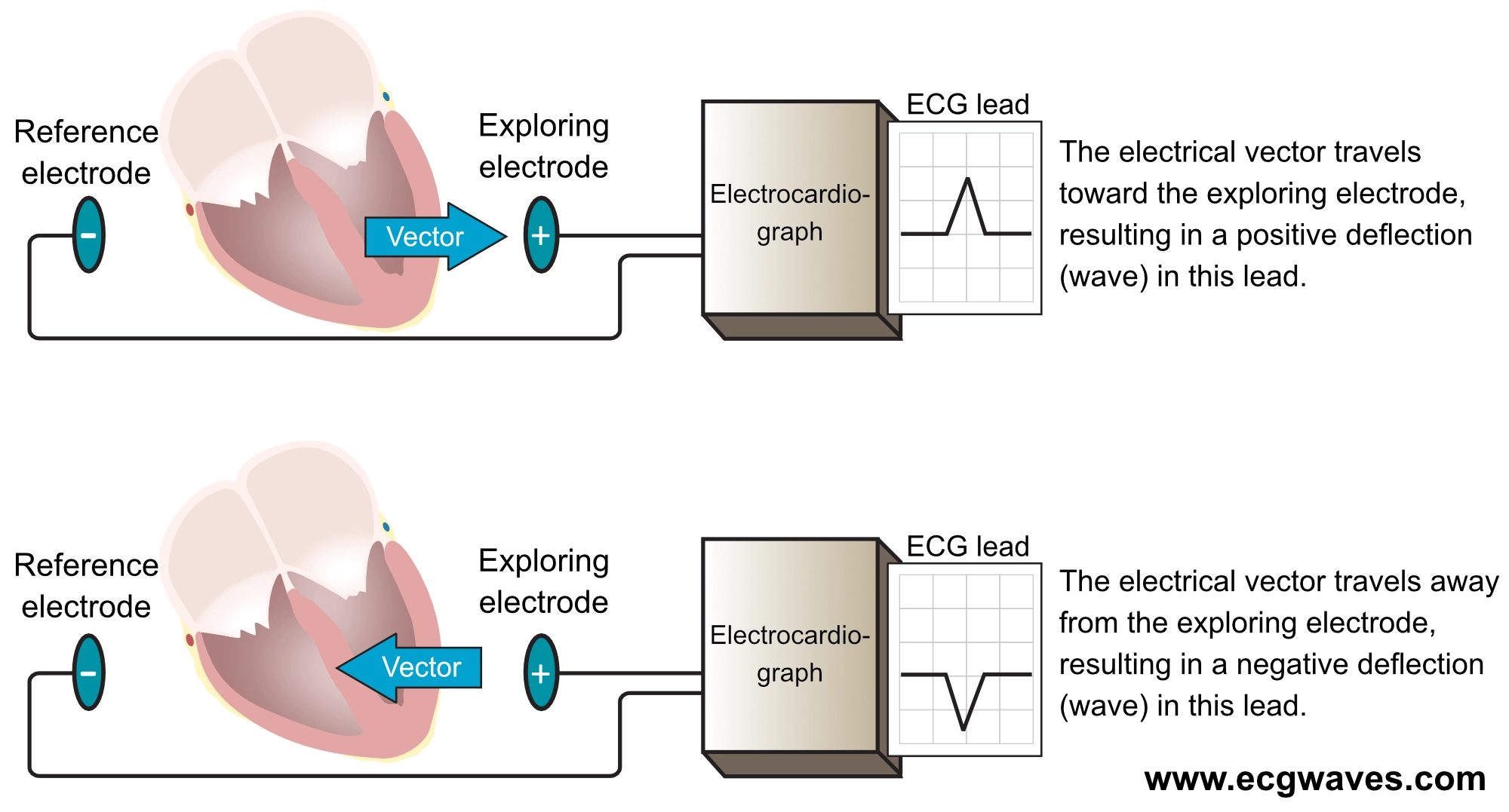 Figur 6. En EKG-avledning viser en EKG-kurve (diagram). Det er nødvendig med minst to elektroder for å få en EKG-avledning. Den ene elektroden fungerer som referanse, og den andre fungerer som utforskningselektrode. Elektrokardiografen sammenligner de elektriske potensialene som registreres i elektrodene. Hvis en vektor beveger seg mot den utforskende elektroden og bort fra referanseelektroden, skrives det ut en positiv bølge.