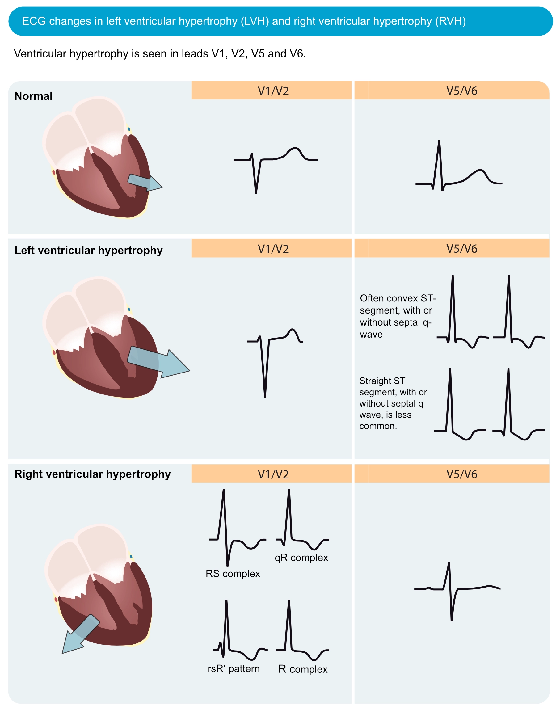 Figur 1. EKG-forandringer ved venstre ventrikkelhypertrofi (LVH) og høyre ventrikkelhypertrofi (RVH). Den elektriske vektoren i venstre ventrikkel er forsterket ved venstre ventrikkelhypertrofi, noe som resulterer i store R-bølger i venstresidige avledninger (V5, V6, aVL og I) og dype S-bølger i høyresidige brystavledninger (V1, V2). Høyre ventrikkelhypertrofi forårsaker store R-bølger i høyresidige brystavledninger og dypere S-bølger i venstresidige avledninger.