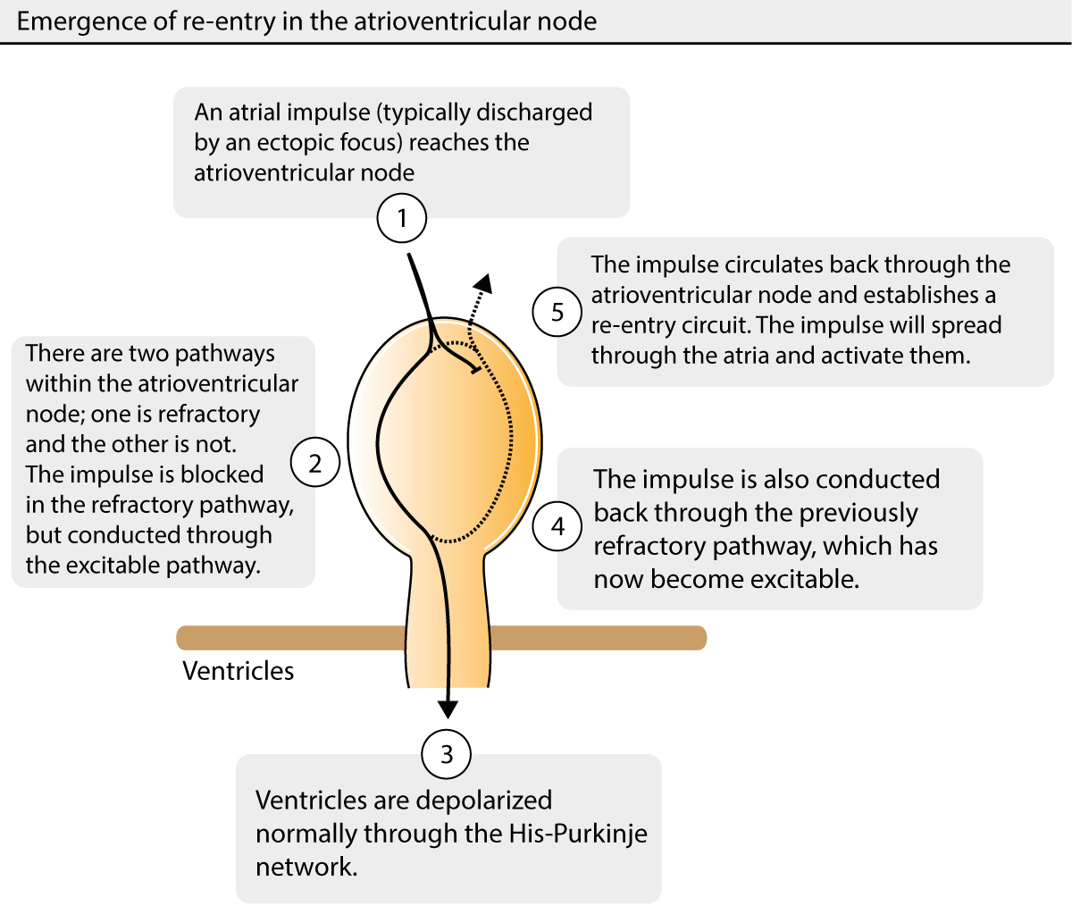 Figure 1. Mechanism leading to atrioventricular nodal reentrant tachycardia (AVNRT).