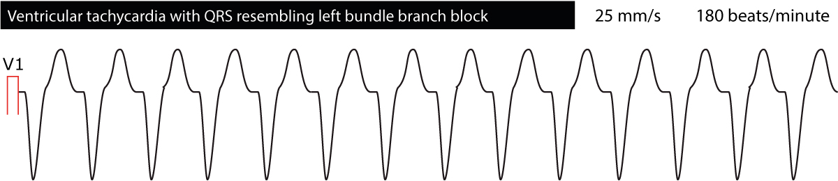 Figure 5. Ventricular tachycardia with left bundle branch block morphology.