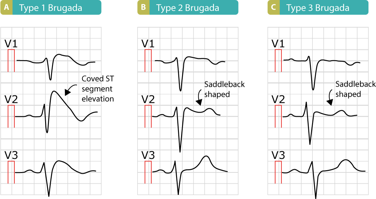 Figure 10. The three types of Brugada syndrome and the characteristic ST segment elevations.