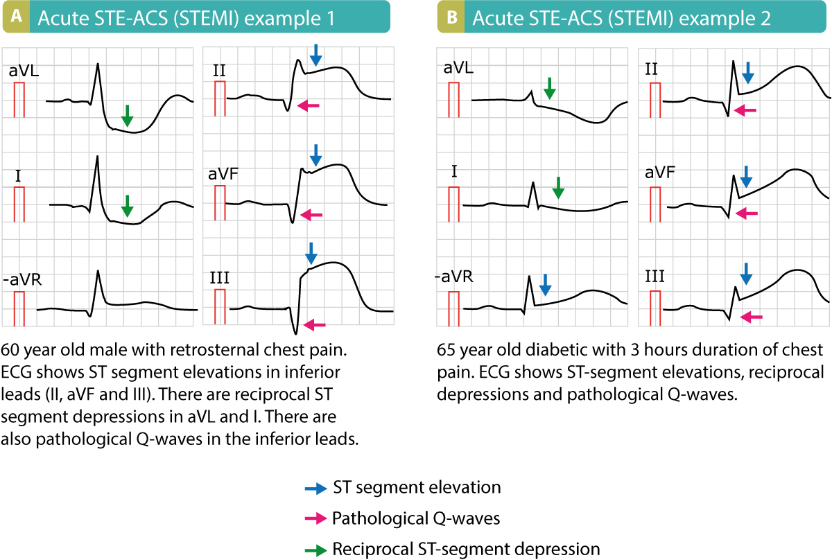 Figure 3. Examples of STE-ACS (STEMI). Note that these patients presented with pathological Q-waves, which means that these ECGs were recorded several hours after symptom onset or those are signs of old infarction.