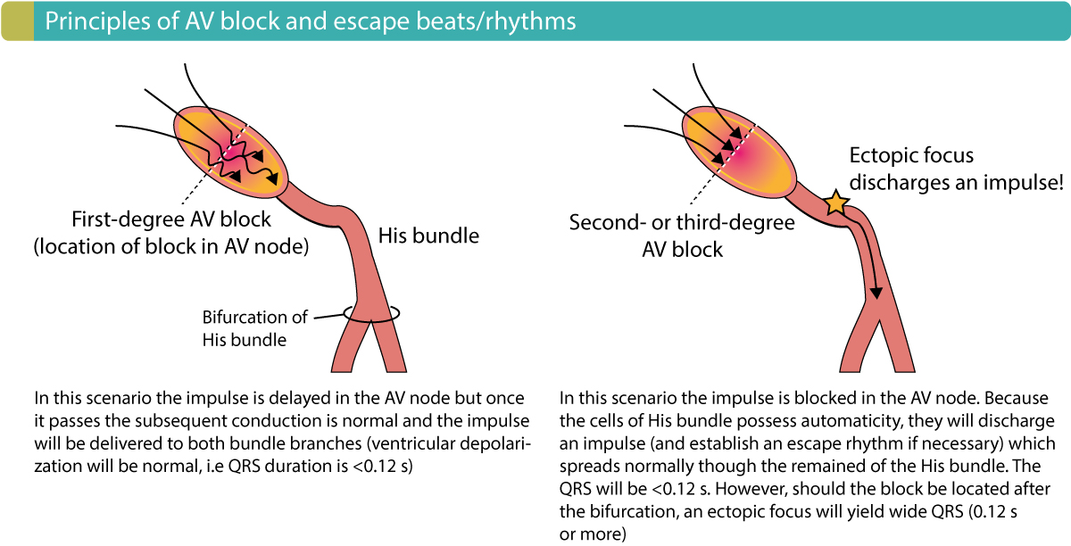 Figure 2. Principles of AV blocks and the emergence of escape rhythms / beats.