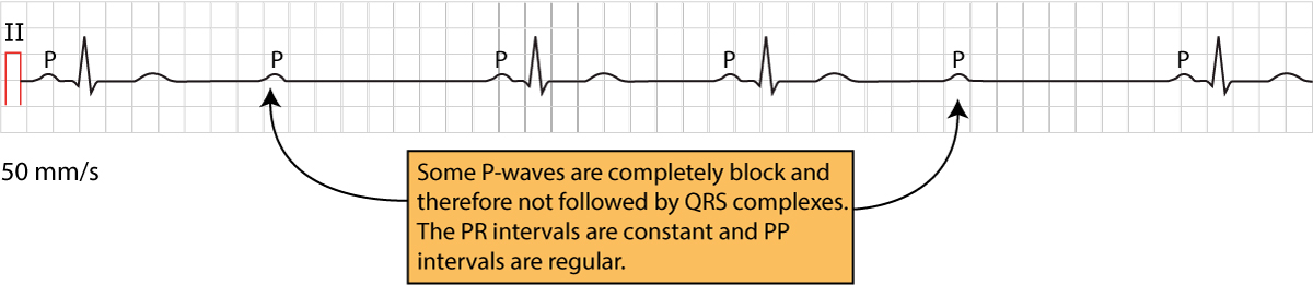 Figure 2. Second-degree AV-block Mobitz type 2.