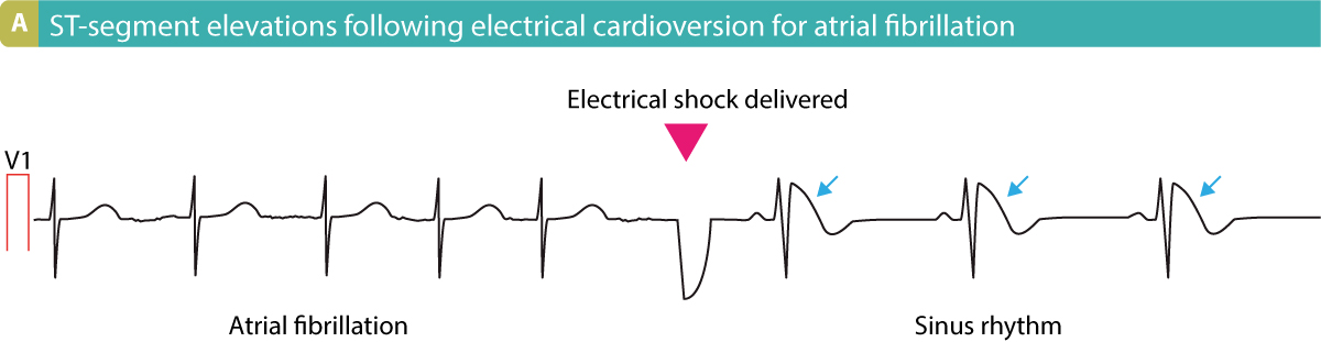Figure 12. Electrical cardioversion resulting in ST-segment elevations.