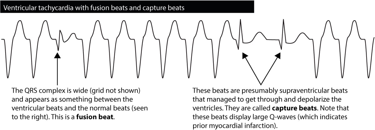 Figure 6. Capture beats and fusion beats seen during ventricular tachycardia.