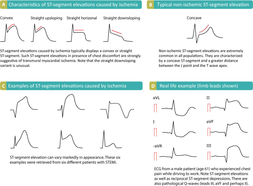 Figure 1. Types of ST segment elevations on ECG.