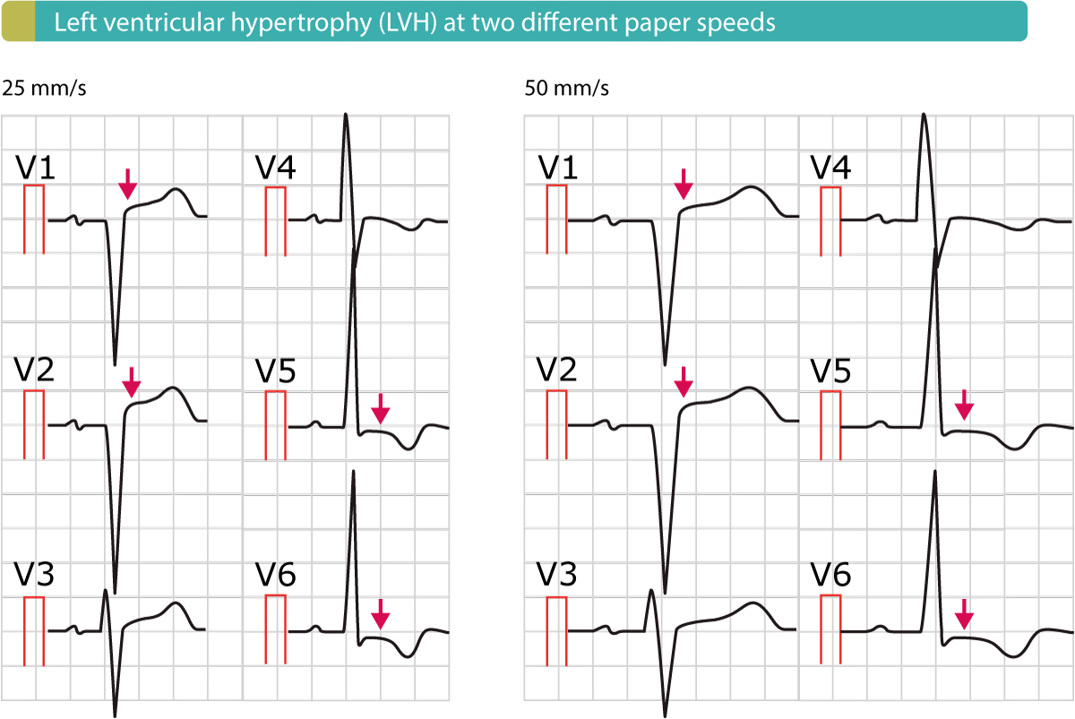 Figure 6. Left ventricular hypertrophy causes secondary ST-T- changes, including ST segment elevations.