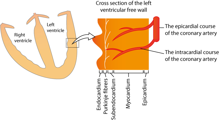 Figure 3. STE-ACS (STEMI) is caused by a complete occlusion, which means that there is no flow in the artery. The ischemia will affect all layers of the myocardium, from the endocardium to the epicardium (in the region supplied by the occluded artery). This type of ischemia, which affects all myocardial layers, is referred to as transmural ischemia.