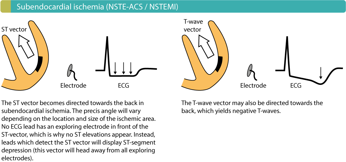 Figure 4. Injury currents in subendocardial ischemia. These are the hallmarks of non-ST segment elevation myocardial infarction (NSTEMI/Non-STEMI).