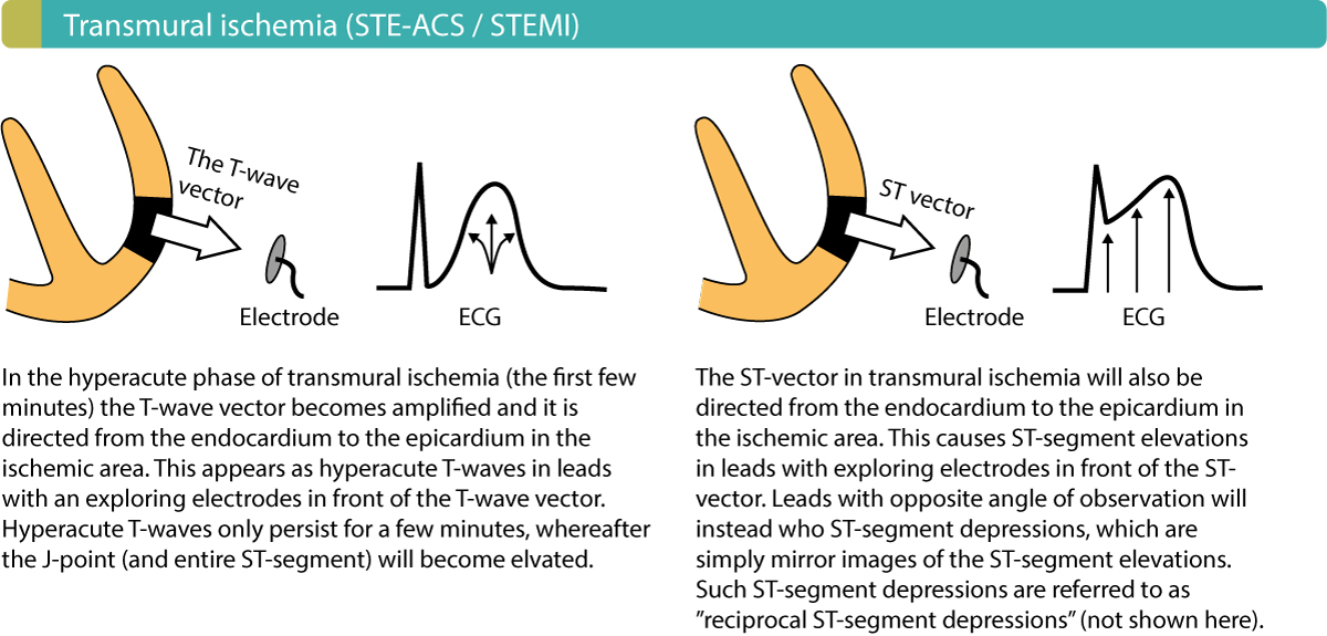 Figure 3. Injury currents in transmural myocardial ischemia. Note that ST segment elevation myocardial infarction (STEMI/STE-ACS) usually also causes ST-segment depressions in leads that are opposite to the leads displaying the ST segment elevations. However, the primary ECG change in STEMI/STE-ACS is the ST segment elevations.
