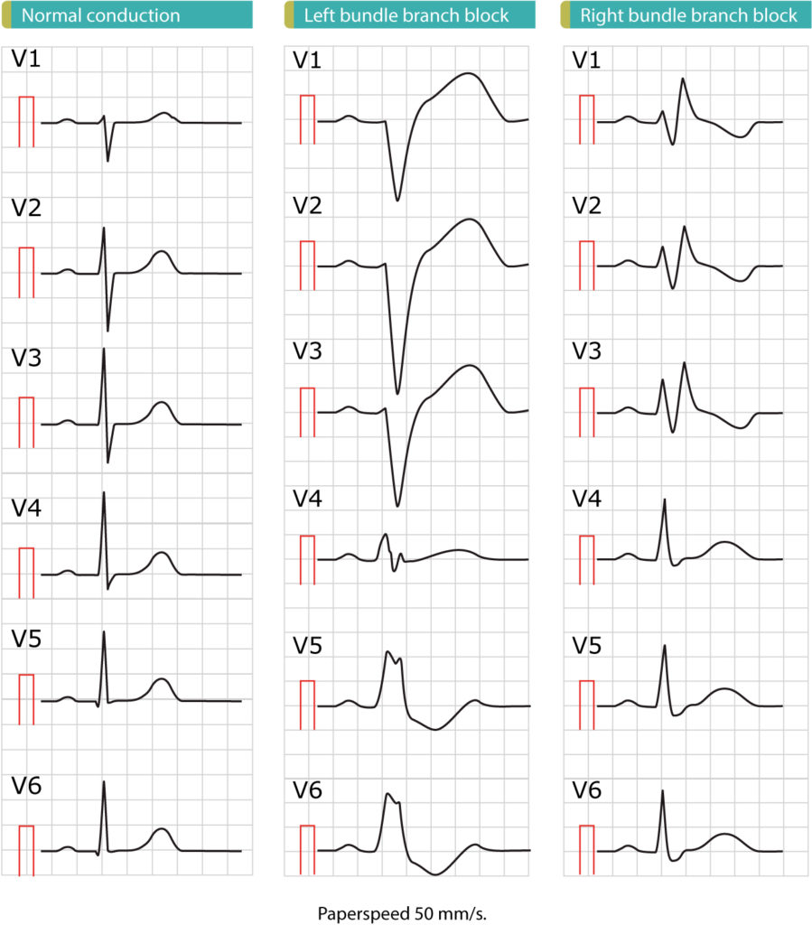 Figure 1. These ECGs show the difference between normal conduction, left bundle branch block (LBBB) and right bundle branch block (RBBB). As evident from these ECGs, the cardinal difference between normal conduction and bundle branch blocks is the QRS duration: bundle branch blocks are caused by dysfunctional bundle branches, which results in slow (and abnormal) activation of ventricular myocardium and thus prolonged QRS duration. A QRS duration of 120 ms (0.12 s) is required to diagnose bundle branch block. Also note that both left bundle branch block (LBBB) and right bundle branch block (RBBB) cause marked ST-T changes, including ST elevations, ST depressions and inverted (negative) T-waves. These ST-T changes are due to abnormal repolarization and they are expected to occur in both LBBB and RBBB. Finally, note that there are marked difference in the ECG pattern between LBBB and RBBB. These ECGs are printed at paperspeed 50 mm/s.