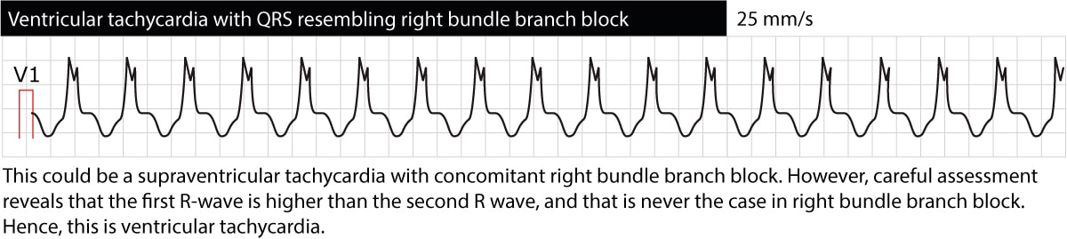 Figure 4. Ventricular tachycardia with right bundle branch block (RBBB) morphology. However, the first R-wave is larger than the second R-wave, which is not the case in RBBB. This suggests that the rhythm is not a supraventricular tachycardia conducted with RBBB, but rather ventricular tachycardia (VT).