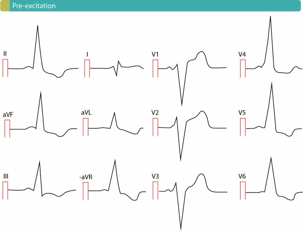 Figure 11. Pre-excitation causes secondary ST-T changes, including ST segment elecations.