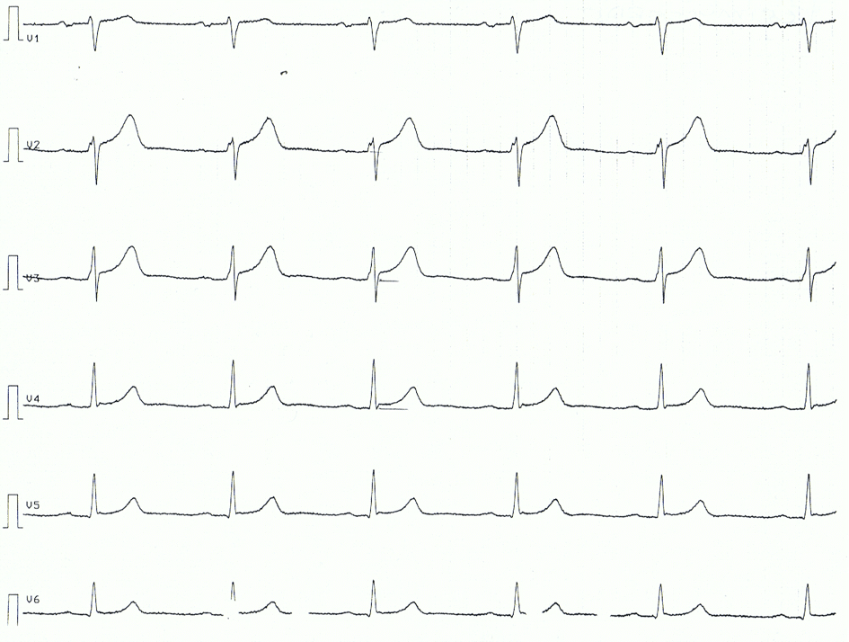 Figure 3. Chest leads of patient with acute pericarditis. Note the ST segment elevations, concave ST segments.