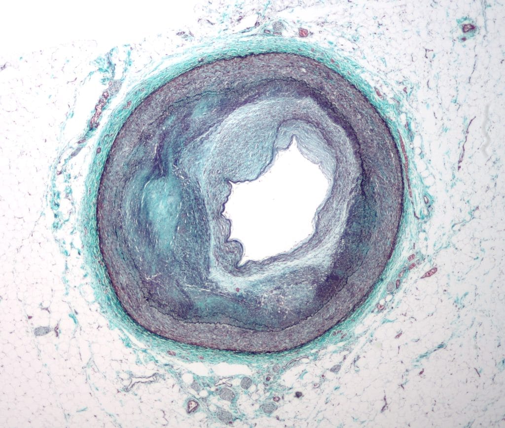 Coronary plaque with reudction of the lumen diameter. This plaque causes myocardial ischemia.