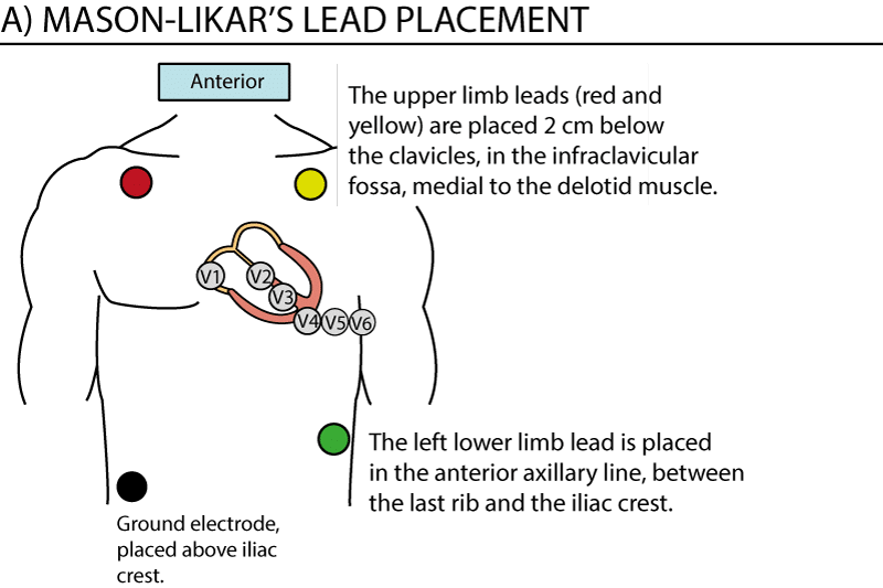 Figure 1. Lead placement for exercise ECG. Note that the precordial (chest) leads are placed normally. The limb leads are relocated to the torso, or proximally on the limbs. The lead placement depicted here is referred to as Mason-Likar's placement, with limb leads on the torso. This reduces artefacts (muscle disturbances) during exercise stress testing.