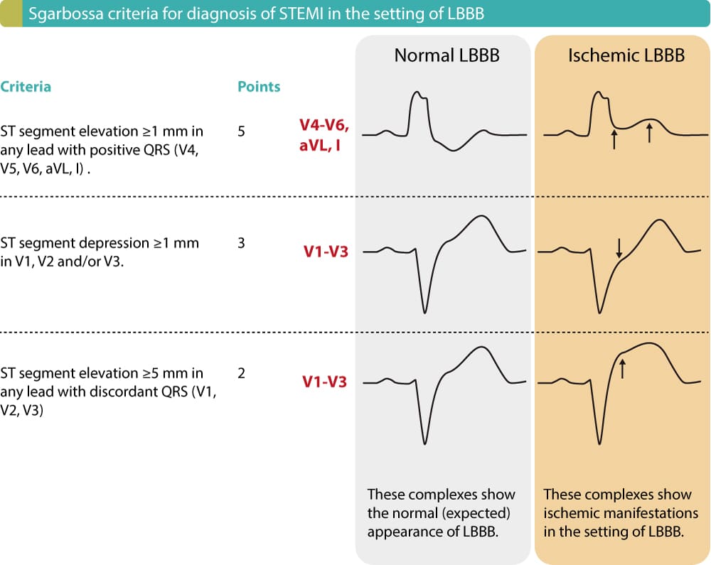 Figure 1. ECG criteria (Sgarbossa criteria) for acute STEMI in the setting of LBBB. Each criteria gives 2 to 5 points. Studies show that a cut-off of ≥3 points yields a sensitivity of 20–36% and specificity of 90–98% for acute STEMI in the setting of LBBB.