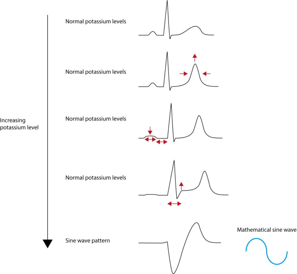 Figure 1. ECG changes seen in hyperkalaemia.