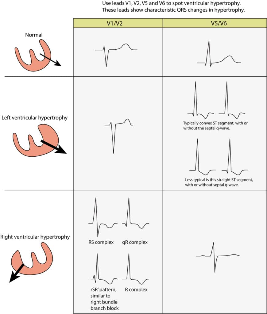 Figure 1. ECG changes seen in left ventricular hypertrophy (LVH) and right ventricular hypertrophy (RVH). The electrical vector of the left ventricle is enhanced in LVH, which results in large R-waves in left sided leads (V5, V6, aVL and I) and deep S-waves in right sided chest leads (V1, V2). Right ventricular hypertrophy causes large R-waves in right sided chest leads and deeper S-waves in left sided leads.