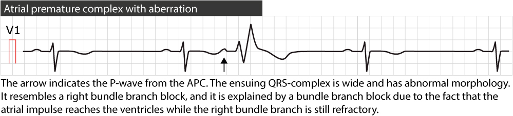 Figure 3. Atrial premature beat conducted with right bundle branch block.