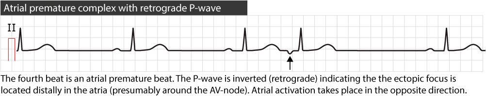 Figure 2. Atrial premature beat with retrograde P-wave.
